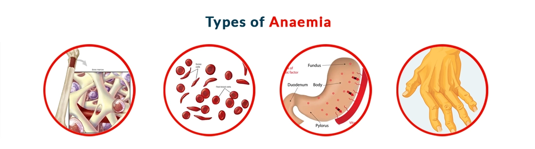 Anaemia Symptoms Causes Diagnosis Treatment And Prevention